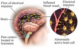know your migraine1