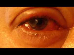 conjunctivitis facts01