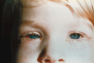 conjunctivitis facts3