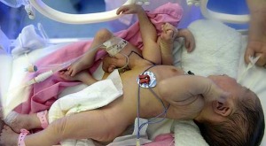 Baby born with four arms and four legs 1