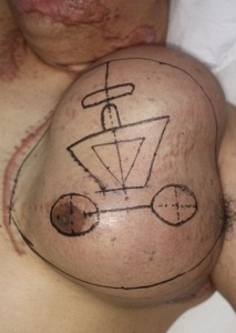 The man with a new face growing on his chest0