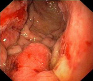 different types of cancer5