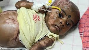 Indian parents claim their six-day-old ‘spontaneously combusted’3