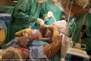 woman-reaches-delivers-twin-babies-caesarean1