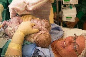woman-reaches-delivers-twin-babies-caesarean2
