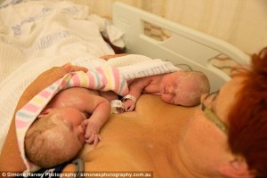 woman-reaches-delivers-twin-babies-caesarean3