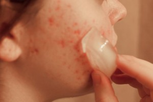 Benefits of Skin Icing3