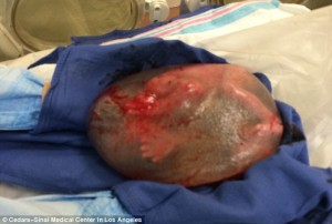 Premature Baby Born Inside Amniotic Sac1