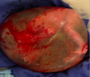 Premature Baby Born Inside Amniotic Sac5