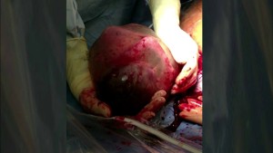 Premature Baby Born Inside Amniotic Sac6