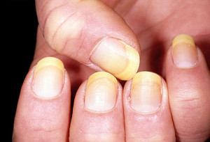 Nails Say About Your Health1
