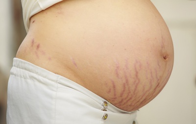 Remedies to Remove Stretch Marks0