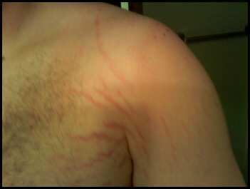 Remedies to Remove Stretch Marks2