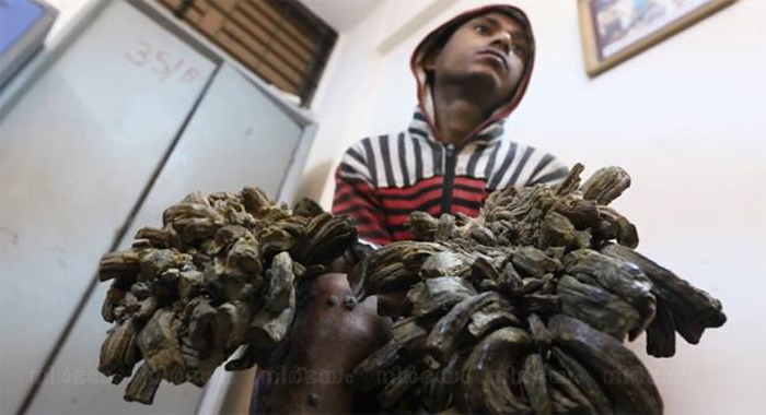 Bangladeshi-man-suffers-rare-condition-that-causes-tree-like-'roots'