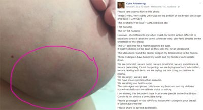 Woman-shares-photo-of-her-breast-to-show-what-cancer-symptoms-look-like1