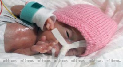 Meet-the-world's-smallest-baby-after-being-born-weighing-8-ounces-2 (1)